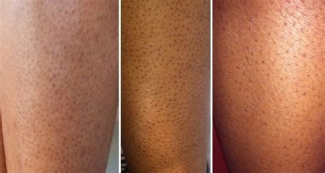 Many Women Have The Problem With Dark Spots On Their Legs They Usually