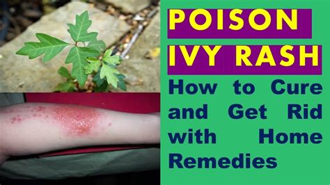 How To Get Rid Of Poison Ivy Rash At Home