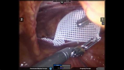 Multiport Robotic Inguinal Hernia Youtube