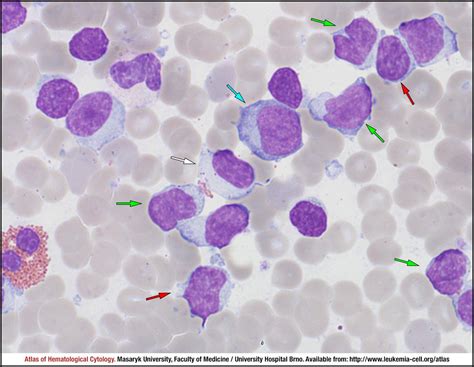 Chronic Lymphocytic Leukaemia Atypical Pleomorphic Variant Mixed