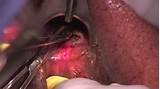 Photos of Colorectal Fistula Treatment