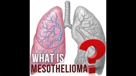 What Is Survival Rates Of Mesothelioma Youtube