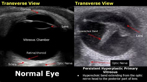 Eye Ultrasound Normal Vs Abnormal Images Cataractretinal Detachment