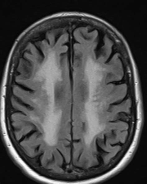 Round Small Hypodense Lesion Brain Mri