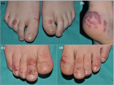 Some symptoms were particularly common, with 31% of the 68 children reporting fever, 18% reporting headache and 19% reporting gastrointestinal symptoms such our data on nearly 250,000 children from the covid symptom study app suggest that children who test positive have a wide range of. 'Pretty conclusive' link between 'COVID toe' and virus ...