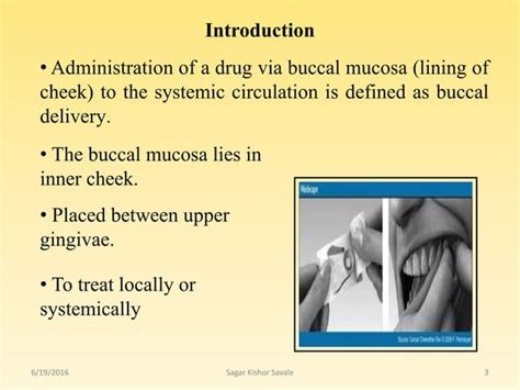 Buccal And Sublingual Drug Delivery System Ppt