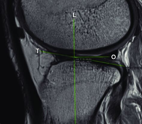 Lateral Plateau Posterior Tibial Slope Pts Measurement L Magnetic