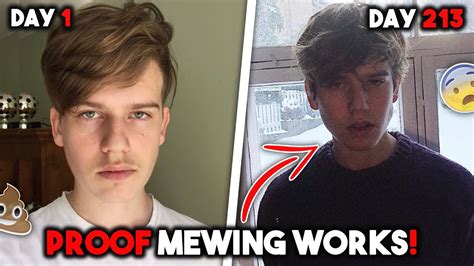 7 Months Mewing Transformation Mewing Before And After Youtube