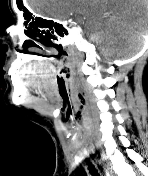 Retropharyngeal Abscess With Peritonsillar Origin Radiology Case