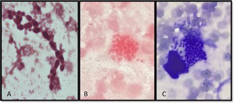 1000x A And B Gram Staining Of The Blood Culture Showing The Presence