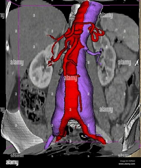 3d Computed Tomographic Ct Scan Reconstruction Of A Dissecting