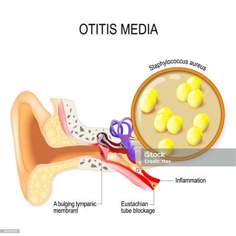 Otitis Media And Staphylococcus Aureus Stock Illustration Download