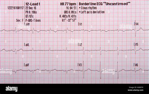 Lead EKG Strip Showing Normal Sinus Rhythm With Unconfirmed Left Stock Photo Alamy