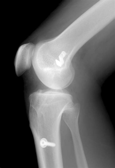 Radiographs Show Anatomic Double Bundle Acl Reconstruction Using