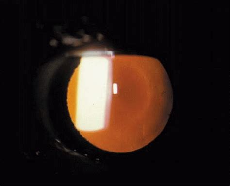 Cataract Clinical Types Ento Key