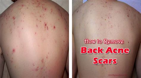 Diy Back Acne Scar Treatment Diy Acne Scars Treatment 10 Home