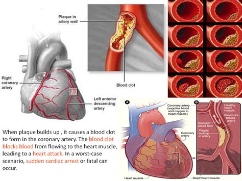 Hardening Of The Arteries Atherosclerosis Arteriosclerosis