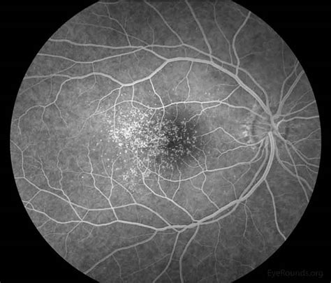Early onset macular drusen and C3 glomerulopathy (formerly type II