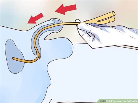 How To Insert A Catheter Wiki Medical Skills