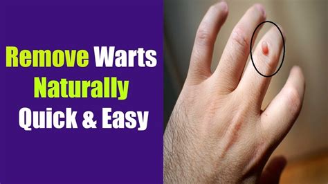How To Get Rid Of Warts Fast Naturally Quick And Easy Methods Youtube