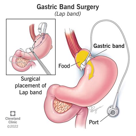 Gastric Band Surgery Lap Band What It Is Requirements And Procedure