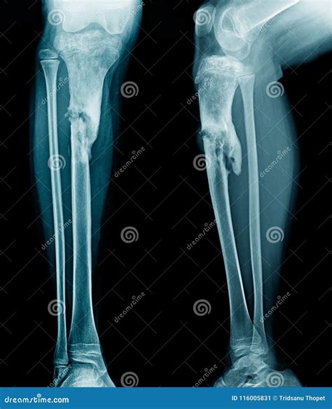 Osteomyelitis Tibia Stock Image Image Of Limb Arthritis 116005831