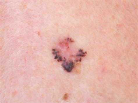 Basal Cell Carcinoma Features