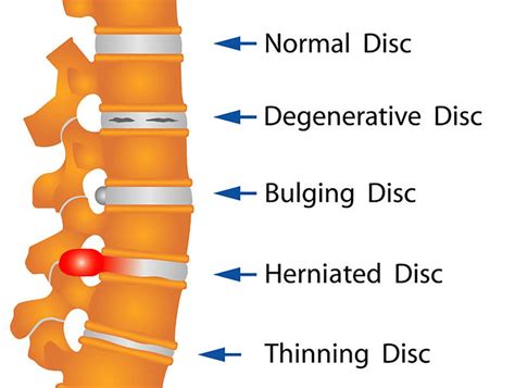 What Does A Disk Bulge Actually Mean Themovementmill