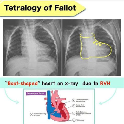 Tetralogy Of Fallot Boot Shaped Heart Medizzy