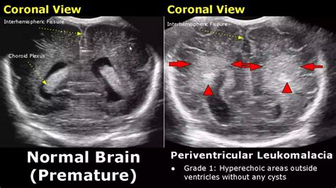 Neonatal Brain Ultrasound Normal Vs Abnormal Images Full Term Infant