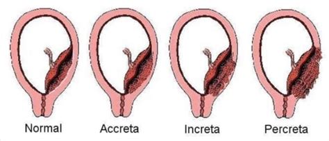 The main symptom of placenta previa is bleeding. Enfermedades en la placenta que pueden impedir otro embarazo