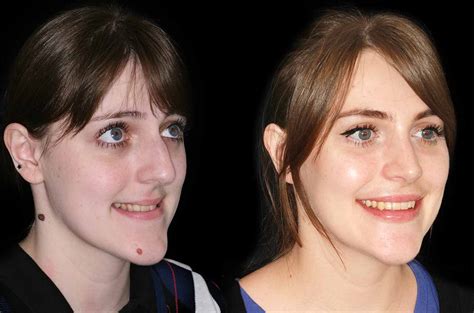 Contouring Of The Mandible Maxillary Advancement Corrective Jaw Surgery Dr Antipov