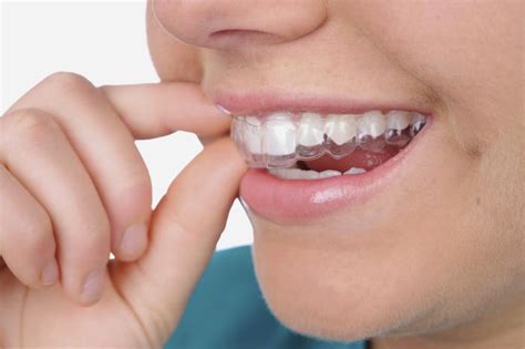 The braces are obviously lost when tex tries to find hyphenation appendix h points out that ligatures are put into a hyphenated word that contains no explicit kerns. Clear Braces vs. Invisible Aligners—What's the Difference ...
