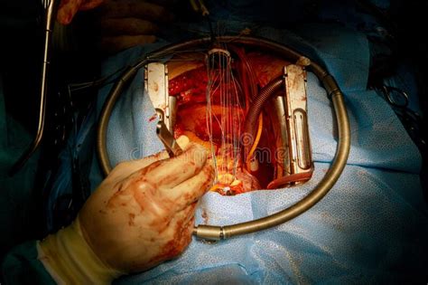 Heart Procedure Surgery Mechanical Replacement Valve