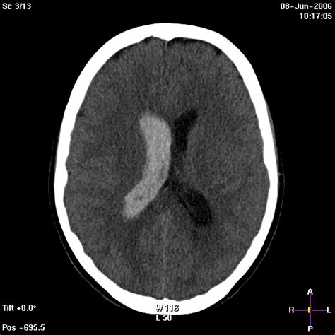 Primary Intraventricular Hemorrhage In An Adult Eurorad
