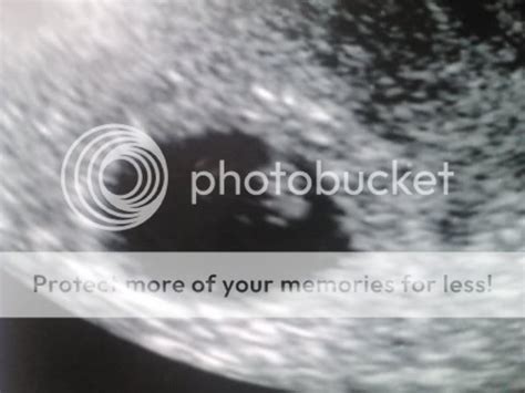 Does This Look Like A Missed Miscarriage Pictures Babycenter