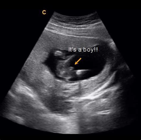 Your risk of miscarriage greatly. Early Gender Boys 14 Weeks | 3D 4D 5D HD Ultrasound Michigan