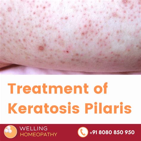 Homeopathy Treatment Of Keratosis Pilaris Best Homeopathy Doctor In
