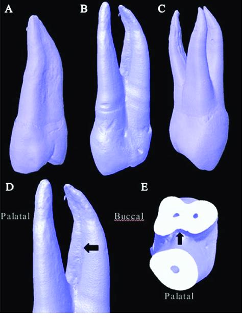 External Root Morphology Of Maxillary First Premolars A Single Root