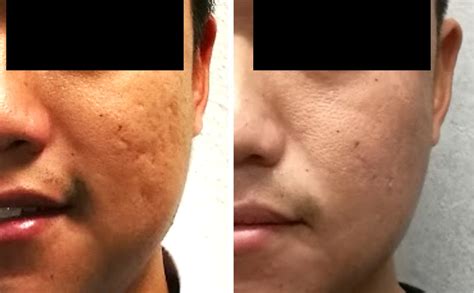 Know Cemsim Ice Pick Scars Before And After Treatment