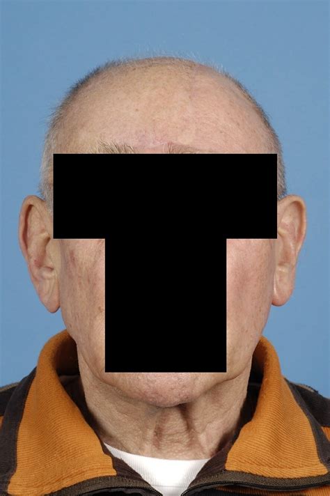 Fileforehead Scalp Defect Picture 4 Wikimedia Commons