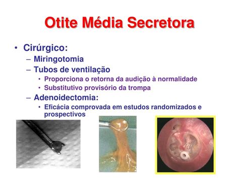 Ppt Otite Média Secretora Powerpoint Presentation Free Download Id