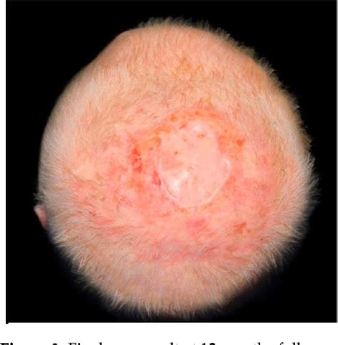 Figure 2 From The Use Of Matriderm For Scalp Full Thickness Defects