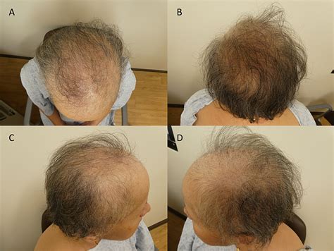(the skin therapy letter journal) cancer is certainly the most notorious one on the list of illnesses that cause hair loss. Cureus | Persistent Alopecia in a Breast Cancer Patient ...