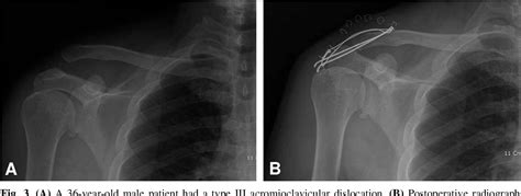 Figure 2 From The Necessity Of Coracoclavicular Ligament Repair In Open