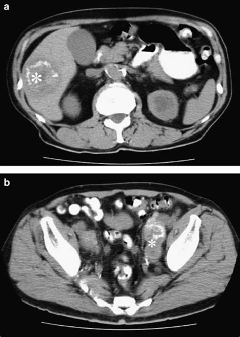Abdominal Computed Tomography Ct Scan Demonstrates Heterogenous Liver