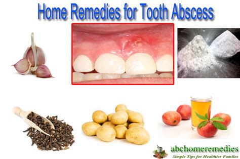 Home Remedies For Tooth Abscess