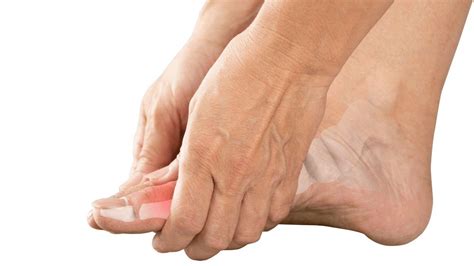 Osteoarthritis Symptoms Causes Treatment The Feet People Podiatry