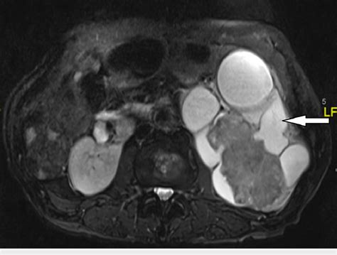 Mri Shows Hydronephrosis Of The Left Kidney With A Large Mass Within It