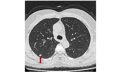 Chest Computed Tomographic Image Reveals A Well Demarcated Round